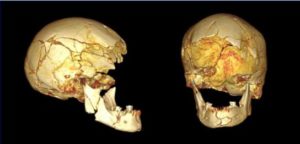 Cráneo de Alfonso I